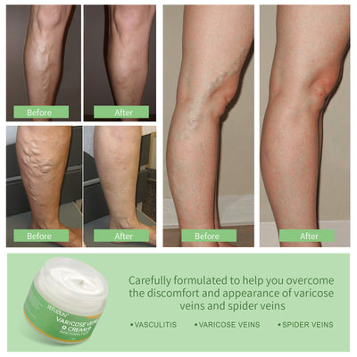 Vein Cream Treatment