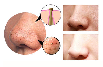 Blackhead Vacuum Extractor