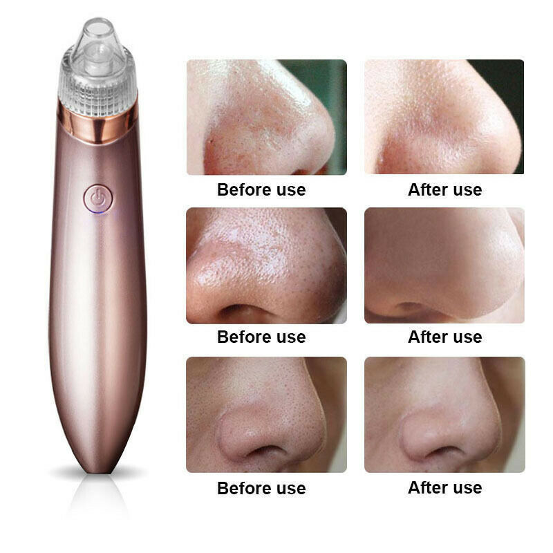 Electric Blackhead Vacuum Remover